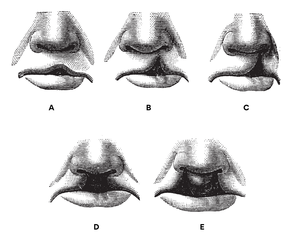 Cleft lip and palate - Types and Treatment